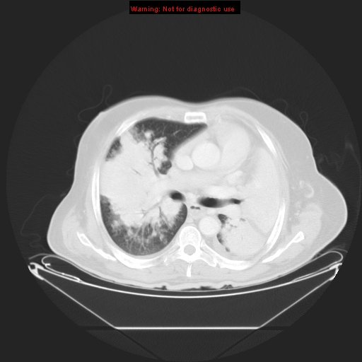 File:Bronchioloalveolar carcinoma (Radiopaedia 9272-9955 Axial lung window 15).jpg