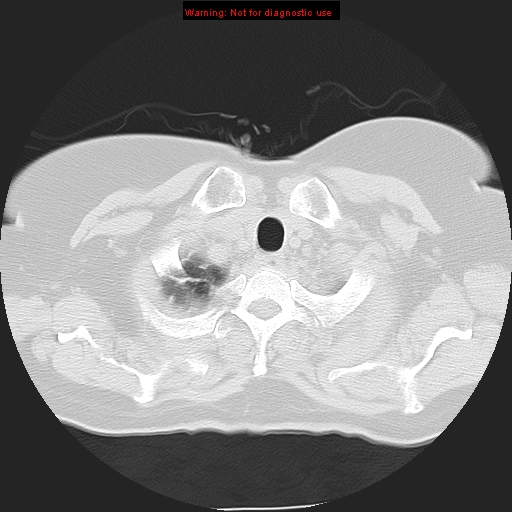 File:Bronchoalveolar carcinoma (Radiopaedia 13224-13233 Axial lung window 6).jpg