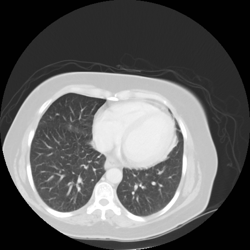 Bronchogenic carcinoma (Radiopaedia 73497-84262 Axial lung window 45).jpg
