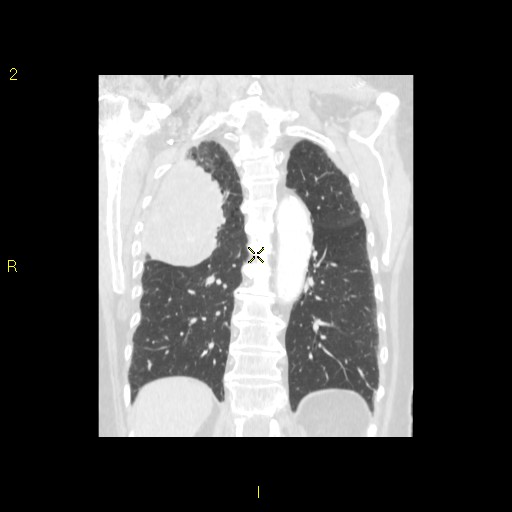 File:Bronchogenic carcinoma as an incidental finding (Radiopaedia 16453-16130 Coronal lung window 36).jpg