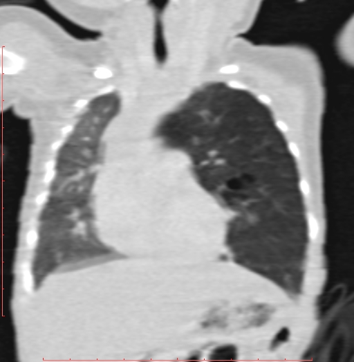Bronchogenic cyst (Radiopaedia 78599-91409 Coronal lung window 90).jpg