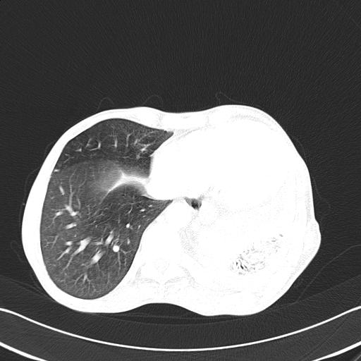 Bronchopleural fistula secondary to tuberculosis (Radiopaedia 20415-20322 Axial lung window 44).jpg