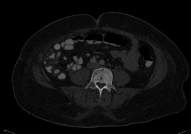 Brown tumors compressing the spinal cord (Radiopaedia 68442-77988 G 76).jpg