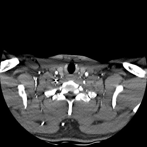 Buccal fat pad arteriovenous malformation (Radiopaedia 70936-81144 D 67).jpg