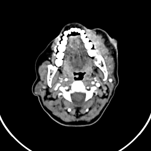 File:Buccal squamous cell carcinoma (Radiopaedia 8520-9346 A 19).jpg