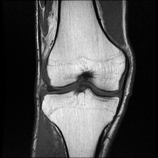 File:Bucket handle tear - medial meniscus (Radiopaedia 69245-79026 Coronal T1 10).jpg
