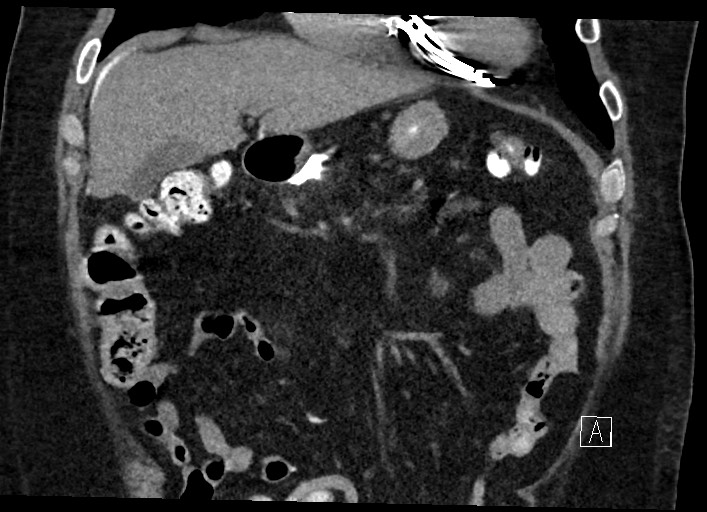 Buried bumper syndrome - gastrostomy tube (Radiopaedia 63843-72577 Coronal Inject 47).jpg