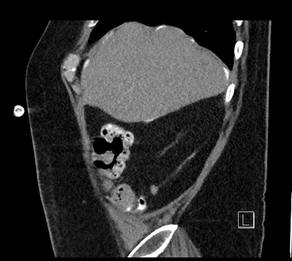 Buried bumper syndrome - gastrostomy tube (Radiopaedia 63843-72577 Sagittal Inject 102).jpg