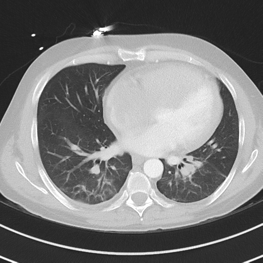 Burkitt lymphoma (Radiopaedia 34686-36121 Axial lung window 30).png