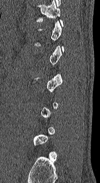 Burst fracture (Radiopaedia 53373-59357 Sagittal bone window 11).jpg