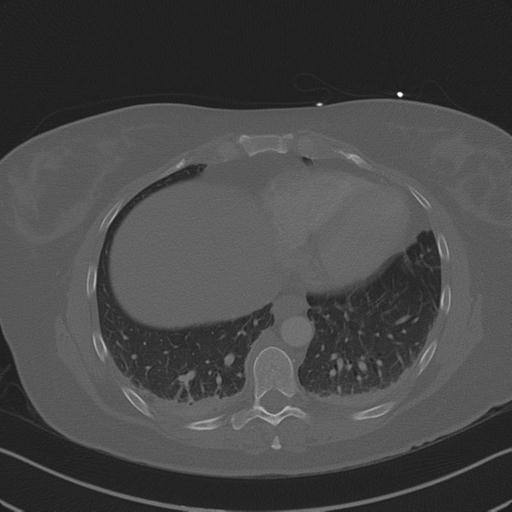 Burst fracture - thoracic spine (Radiopaedia 30238-30865 Axial bone window 65).jpg