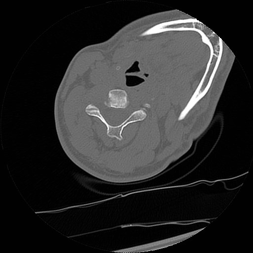 C1-C2 "subluxation" - normal cervical anatomy at maximum head rotation (Radiopaedia 42483-45607 Axial non-contrast 13).jpg