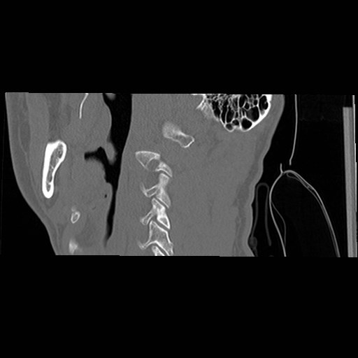 C1-C2 "subluxation" - normal cervical anatomy at maximum head rotation (Radiopaedia 42483-45607 C 54).jpg