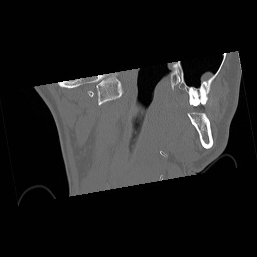 C1-C2 "subluxation" - normal cervical anatomy at maximum head rotation (Radiopaedia 42483-45607 Coronal non-contrast 8).jpg