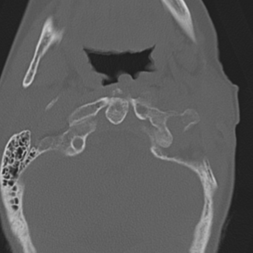 File:C2 fracture with vertebral artery dissection (Radiopaedia 37378-39199 Axial bone window 11).png