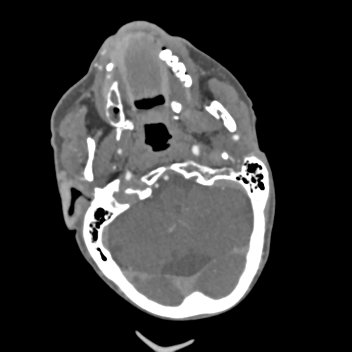 File:C2 fracture with vertebral artery dissection (Radiopaedia 37378-39200 A 194).png