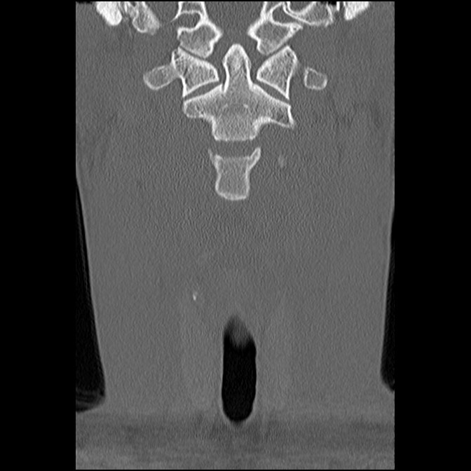 C5 facet fracture (Radiopaedia 58374-65499 Coronal bone window 20).jpg