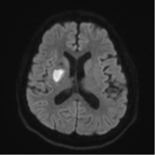 File:CNS vasculitis (Radiopaedia 55715-62263 Axial DWI 46).png