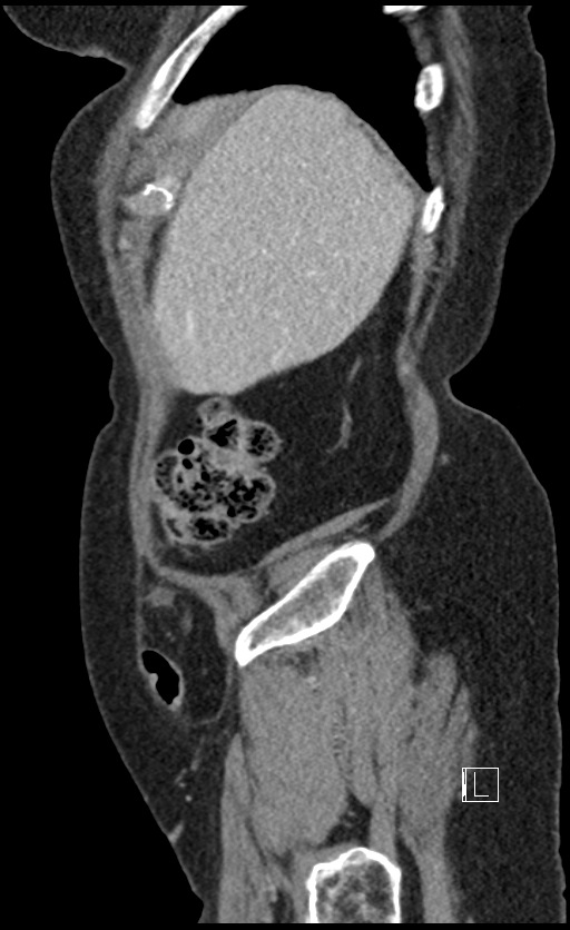 Calcified adrenal glands and Spigelian hernia (Radiopaedia 49741-54988 C 141).jpg