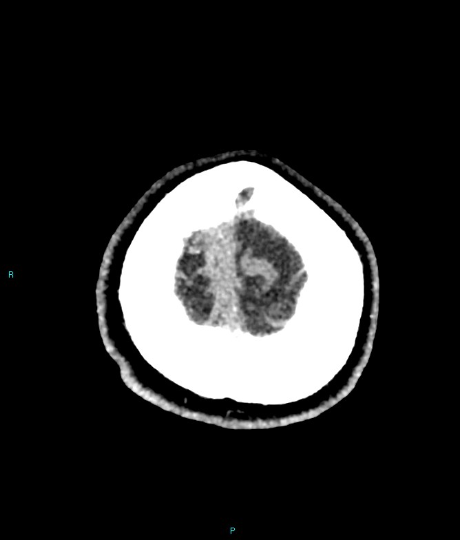 Calcified cerebral emboli from left ventricular thrombus (Radiopaedia 84420-99758 Axial non-contrast 8).jpg