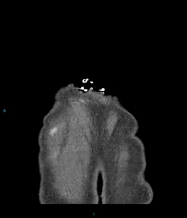 Calcified cerebral emboli from left ventricular thrombus (Radiopaedia 84420-99760 Coronal C+ CTPA 2).jpg