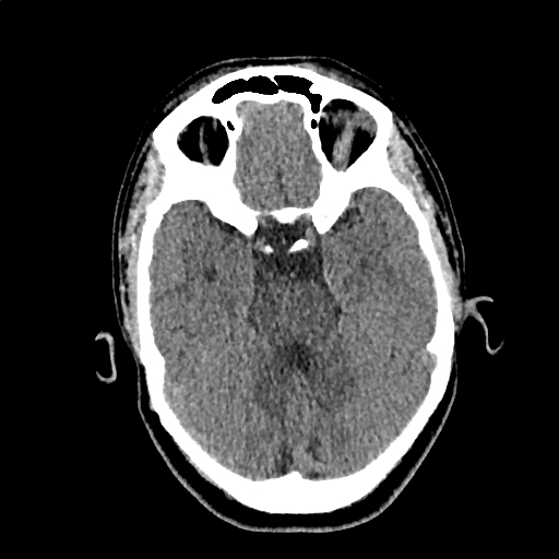 File:Calcified cerebral hydatid cyst (Radiopaedia 65603-74717 Axial non-contrast 19).jpg