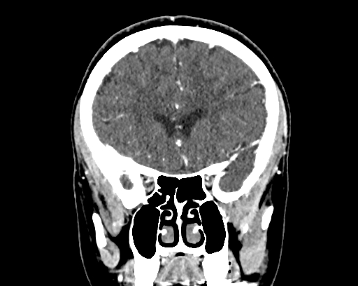 Calcified cerebral hydatid cyst (Radiopaedia 65603-74717 C 21).jpg