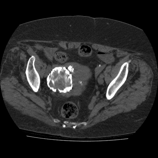 File:Calcified fibroids (Radiopaedia 16853-16579 non-contrast 6).jpg