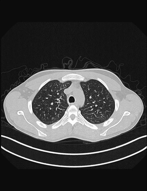 Calcifying pulmonary metastases (Radiopaedia 33359-34396 Axial lung window 17).jpg