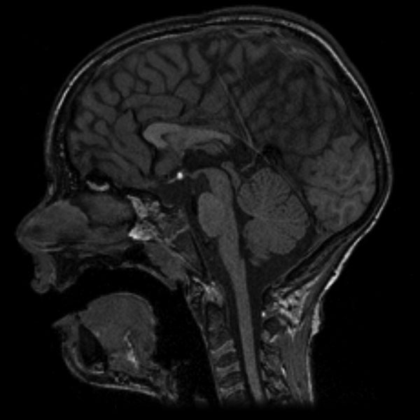 File:Callosal dysgenesis and ectopic posterior pituitary (Radiopaedia 8382-9213 Sagittal T1 1).jpg