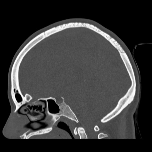 Calvarial osteoma (Radiopaedia 36520-38079 Sagittal bone window 55).jpg