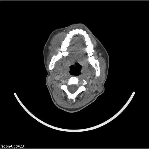 Carcinoma of the maxillary antrum (Radiopaedia 53805-59888 Axial C+ delayed 38).jpg