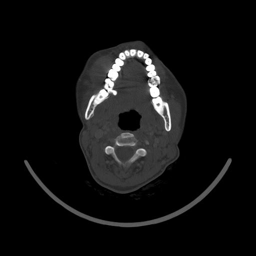 Carcinoma of the maxillary antrum (Radiopaedia 53805-59888 Axial bone window 91).jpg