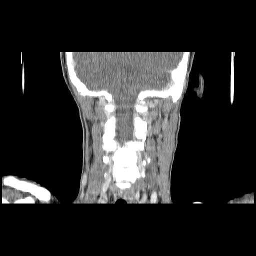 Carcinoma of the maxillary antrum (Radiopaedia 53805-59888 Coronal C+ delayed 120).jpg
