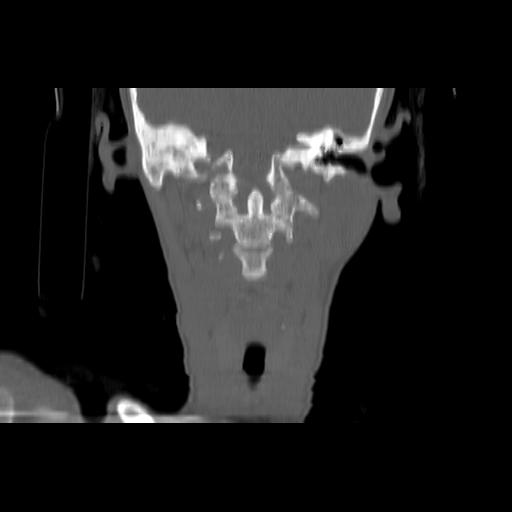Carcinoma of the maxillary antrum (Radiopaedia 53805-59888 Coronal bone window 95).jpg