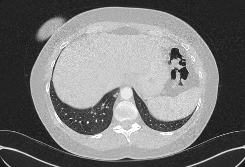 File:Cardiac sarcoidosis (Radiopaedia 74548-85534 Axial lung window 79).jpg