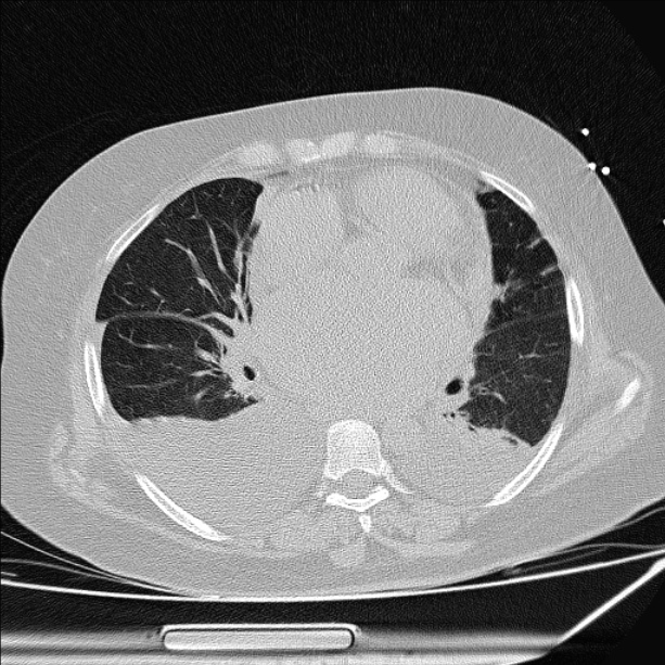 Cardiogenic pulmonary edema (Radiopaedia 29213-29609 Axial lung window 55).jpg