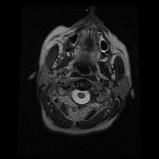 File:Carotid arterial dissection (Radiopaedia 30001-30547 Axial T2 4).jpg