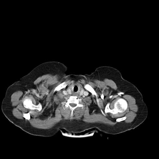 Carotid body tumor (Radiopaedia 21021-20948 A 23).jpg
