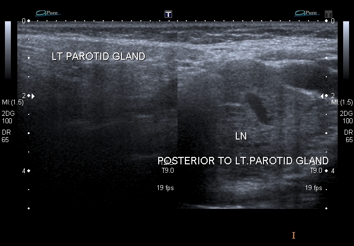File:Carotid body tumor (paraganglioma) (Radiopaedia 38586-40728 various 6).jpg