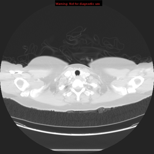 Carotid body tumor with lung metastases (Radiopaedia 9301-48390 Axial lung window 9).jpg