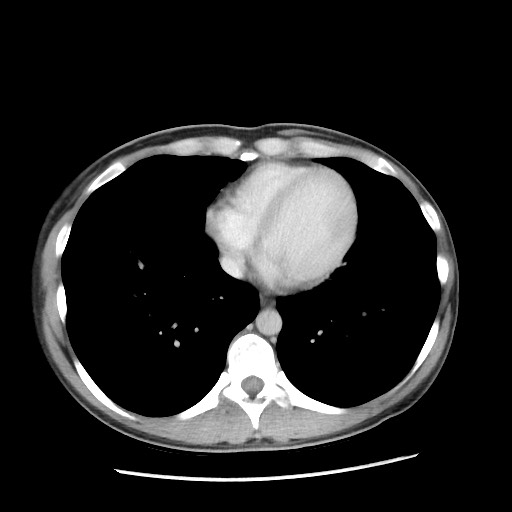 Castleman disease with fibrous pseudotumor in the abdomen (Radiopaedia 77296-89373 A 1).jpg