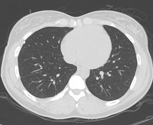 File:Catamenial pneumothorax (Radiopaedia 54382-60600 Axial 40).png