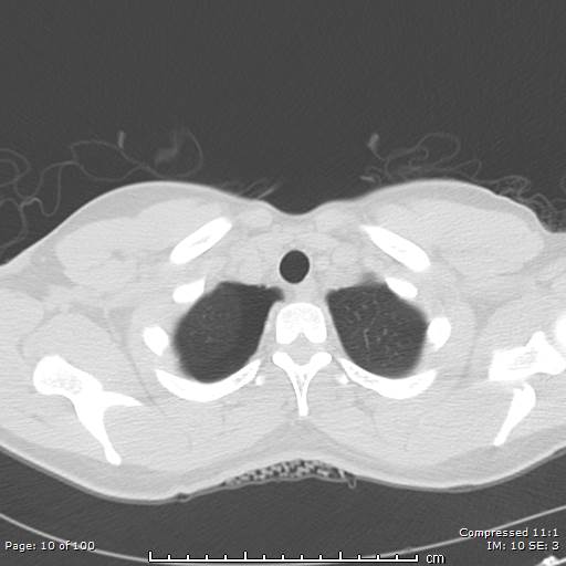 Catamenial pneumothorax (Radiopaedia 54382-60600 Axial non-contrast 10).jpg
