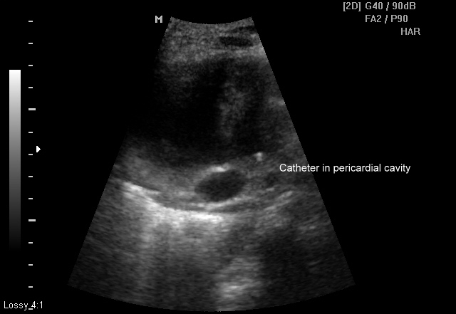 File:Catheter drainage of tuberculous pericarditis (Radiopaedia 6903-8034 Transverse 1).jpg