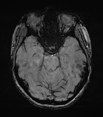 File:Cavernoma with bleed - midbrain (Radiopaedia 54546-60773 Axial SWI 18).png