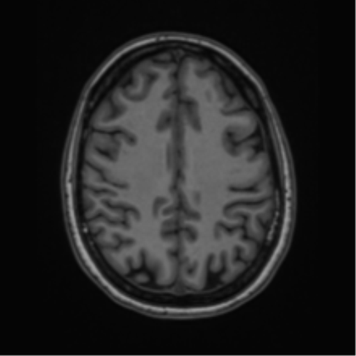 Cavernoma with bleed - midbrain (Radiopaedia 54546-60774 Axial T1 38).png