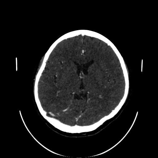 Cavernoma with developmental venous anomaly (Radiopaedia 22470-22506 C 86).jpg
