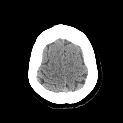 Cavernoma with hemorrhage (Radiopaedia 70755-80931 Axial non-contrast 45).png
