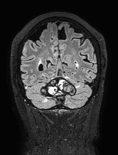 Cavernous hemangioma of the cerebellar falx (Radiopaedia 73025-83724 Coronal FLAIR 273).jpg
